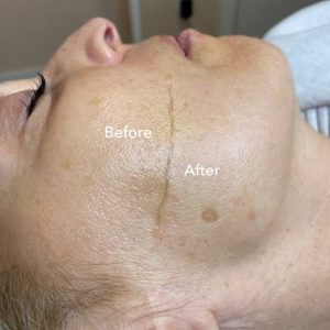 درماپلنینگ